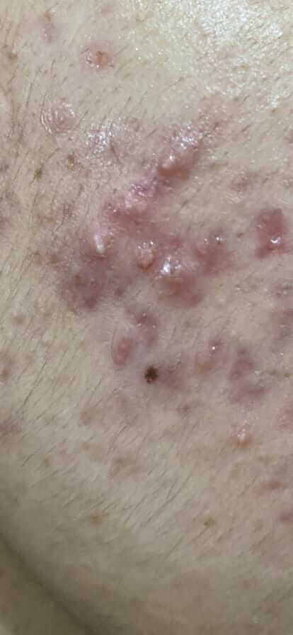 Acne Treatment